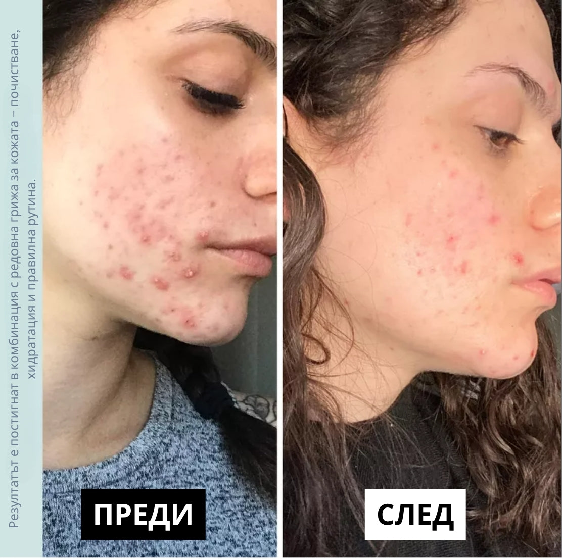 Laurel Derma - Дарсонвал Pro Wireless